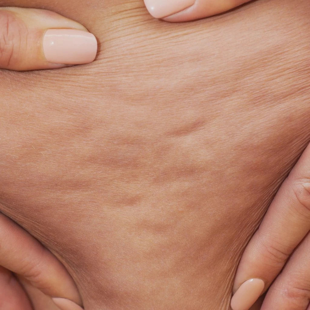 Cellulite van dichtbij
