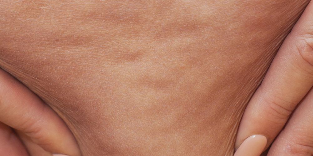 Cellulite en cellulitis: een Begrip van verschillen en zelfacceptatie