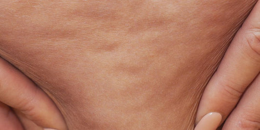Cellulite en cellulitis: een Begrip van verschillen en zelfacceptatie