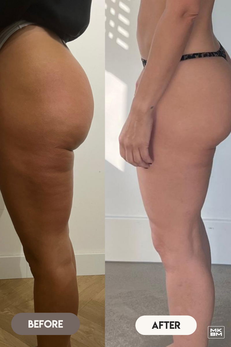 Cellulite Cups + Gratis Celulite Guide