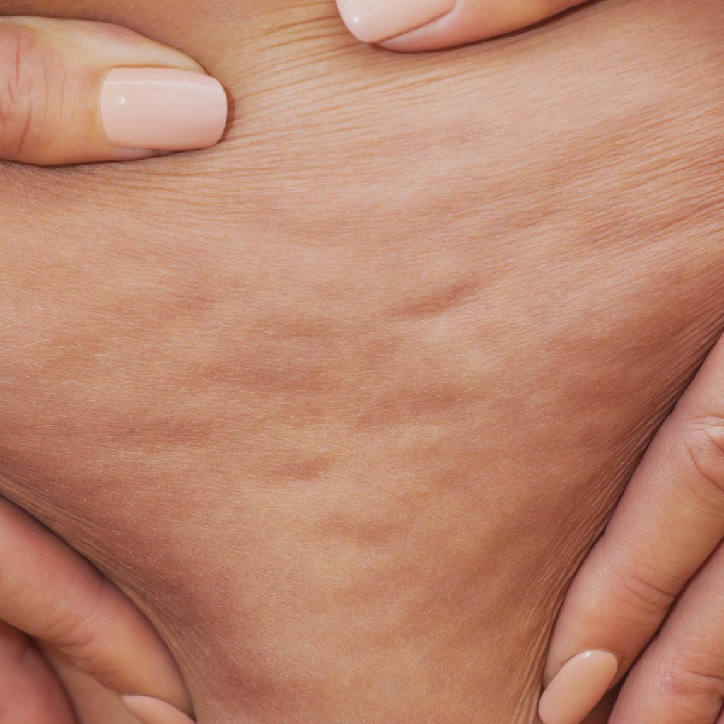 Cellulite van dichtbij